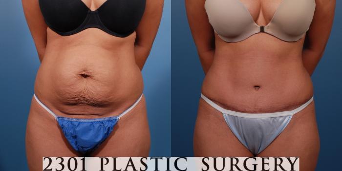 Before & After Tummy Tuck Case 147 View #1 View in Fort Worth, Plano, & Frisco, Texas