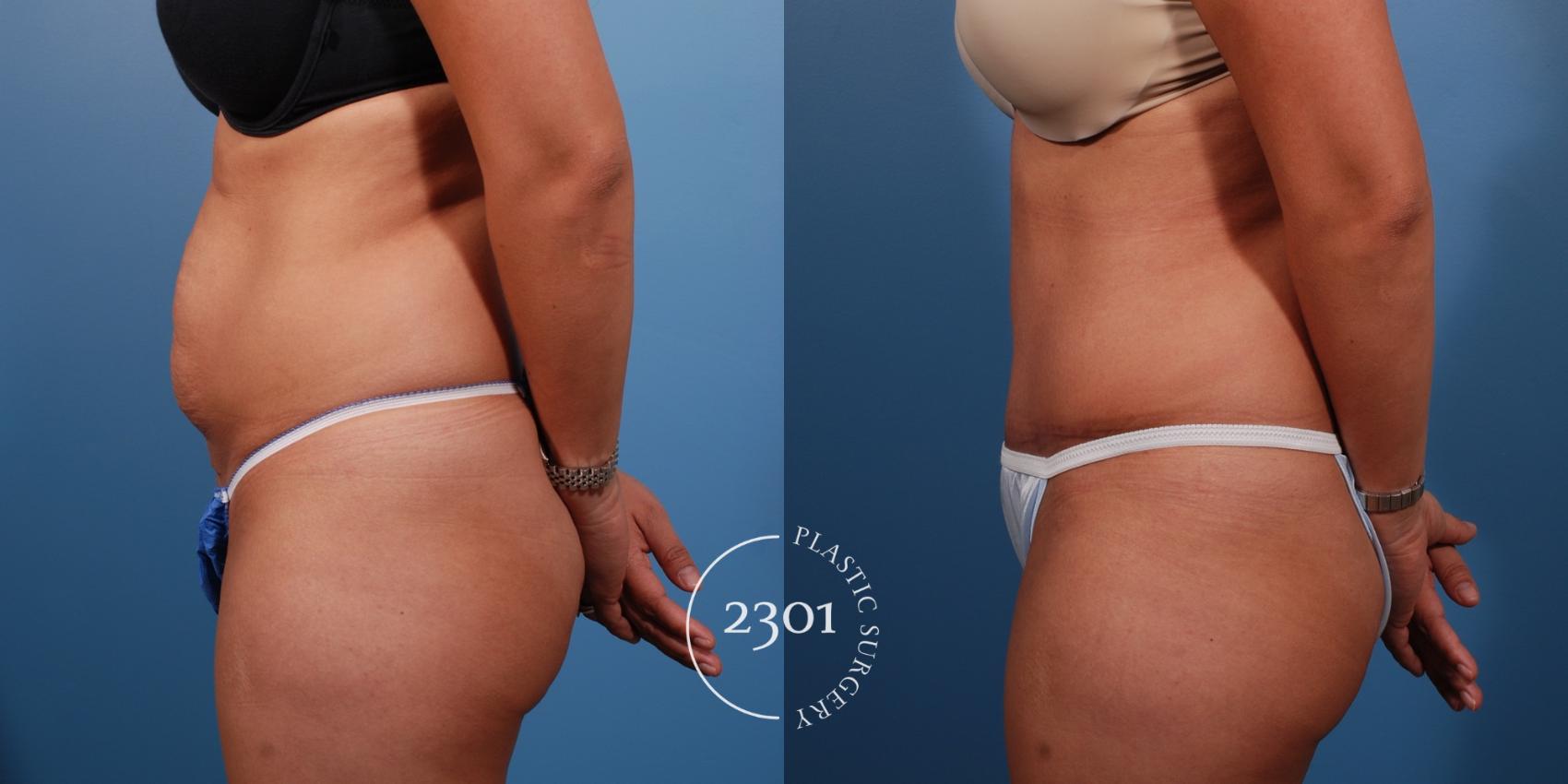 Before & After Tummy Tuck Case 147 View #2 View in Fort Worth, Plano, & Frisco, Texas