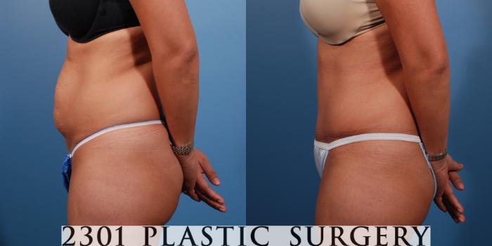 Before & After Tummy Tuck Case 147 View #2 View in Fort Worth, Plano, & Frisco, Texas