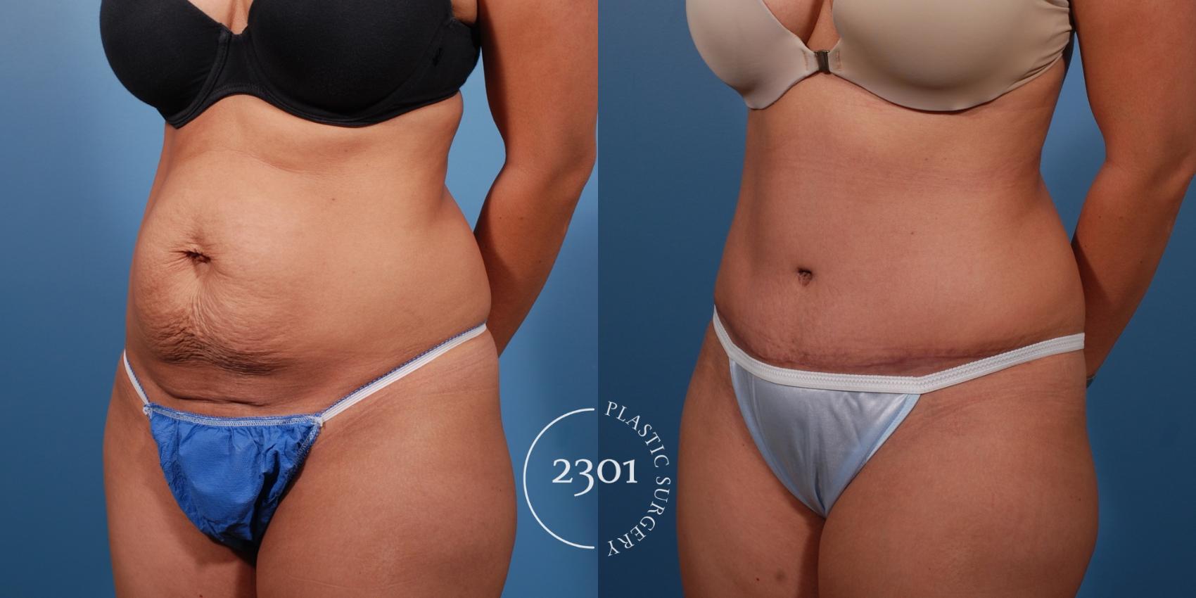 Before & After Tummy Tuck Case 147 View #3 View in Fort Worth, Plano, & Frisco, Texas