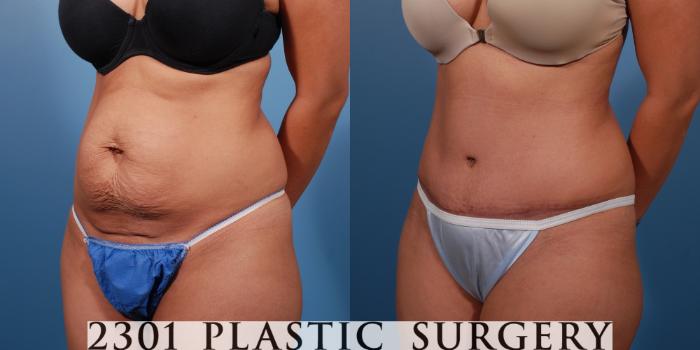 Before & After Tummy Tuck Case 147 View #3 View in Fort Worth, Plano, & Frisco, Texas