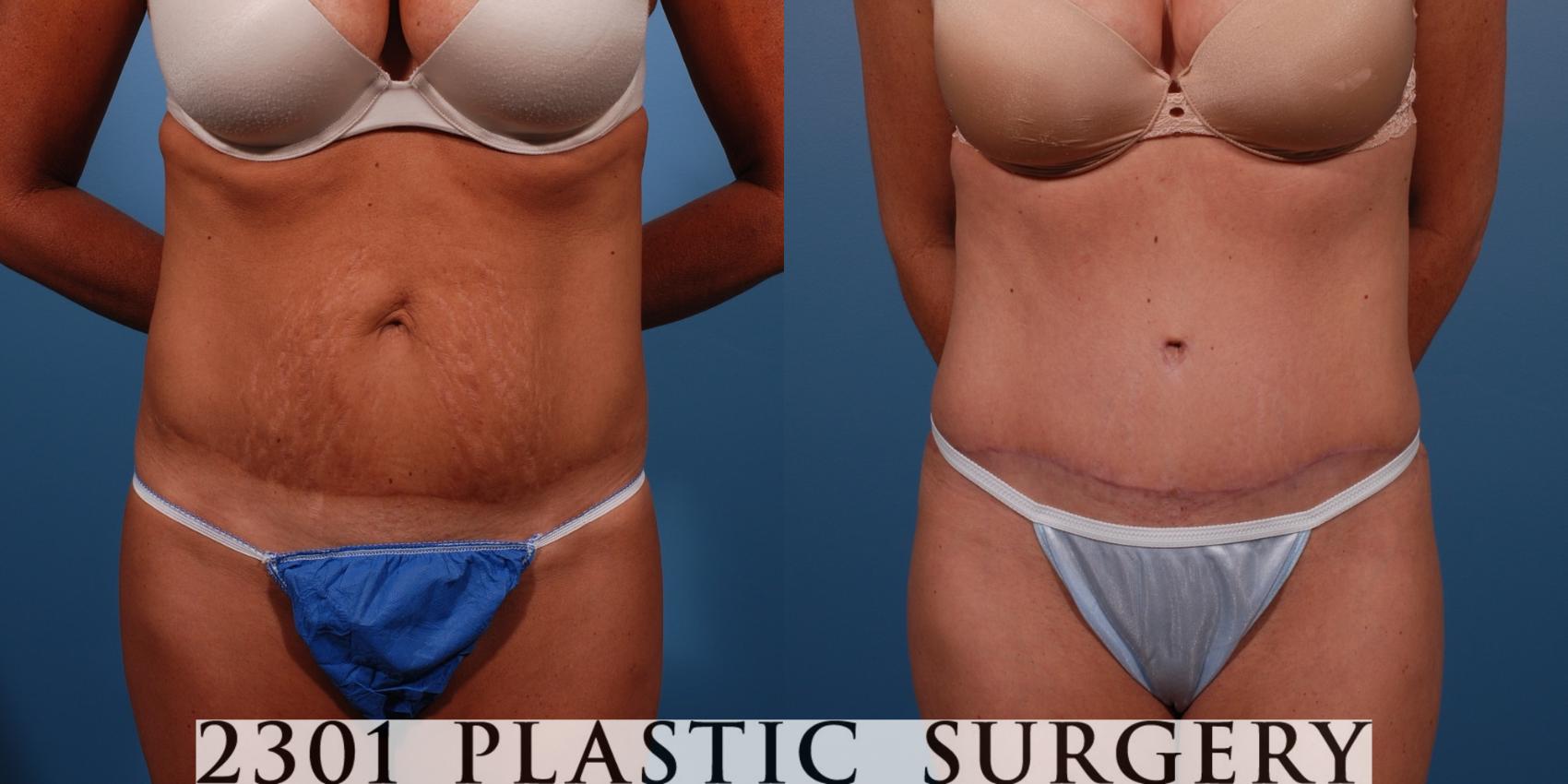 Before & After Tummy Tuck Case 149 View #1 View in Fort Worth, Plano, & Frisco, Texas