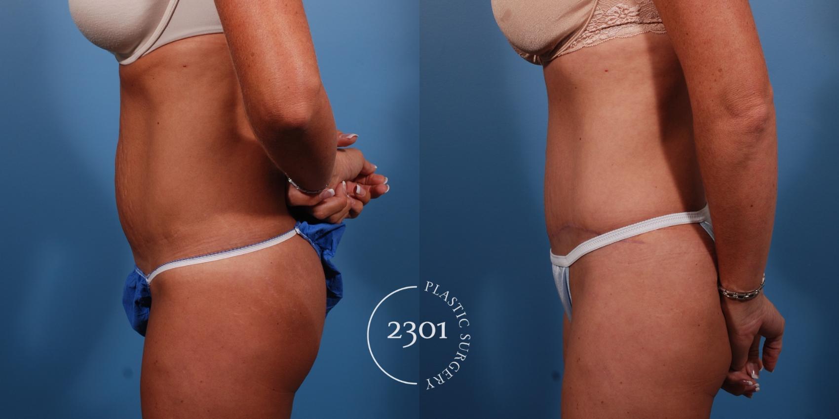 Before & After Tummy Tuck Case 149 View #2 View in Fort Worth, Plano, & Frisco, Texas