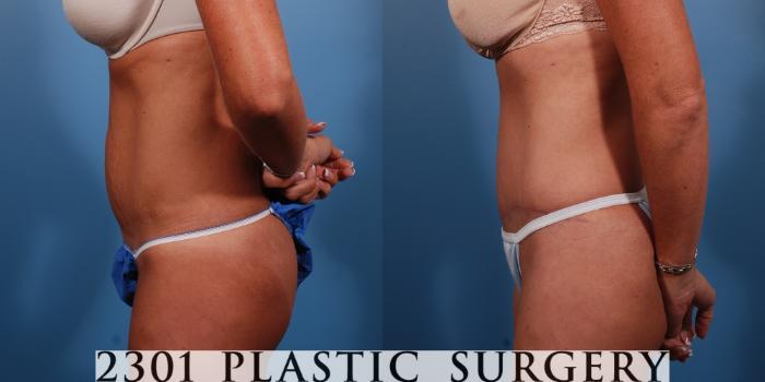 Before & After Tummy Tuck Case 149 View #2 View in Fort Worth, Plano, & Frisco, Texas
