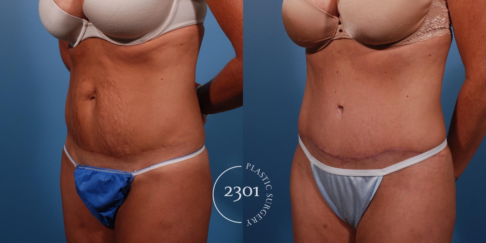 Before & After Tummy Tuck Case 149 View #3 View in Fort Worth, Plano, & Frisco, Texas
