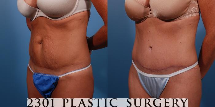Before & After Tummy Tuck Case 149 View #3 View in Fort Worth, Plano, & Frisco, Texas