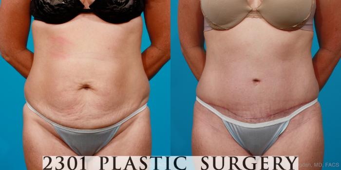 Before & After Tummy Tuck Case 155 View #1 View in Fort Worth, Plano, & Frisco, Texas