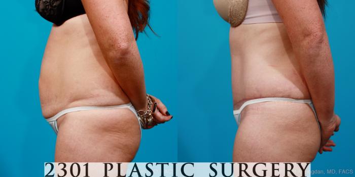 Before & After Tummy Tuck Case 155 View #2 View in Fort Worth, Plano, & Frisco, Texas