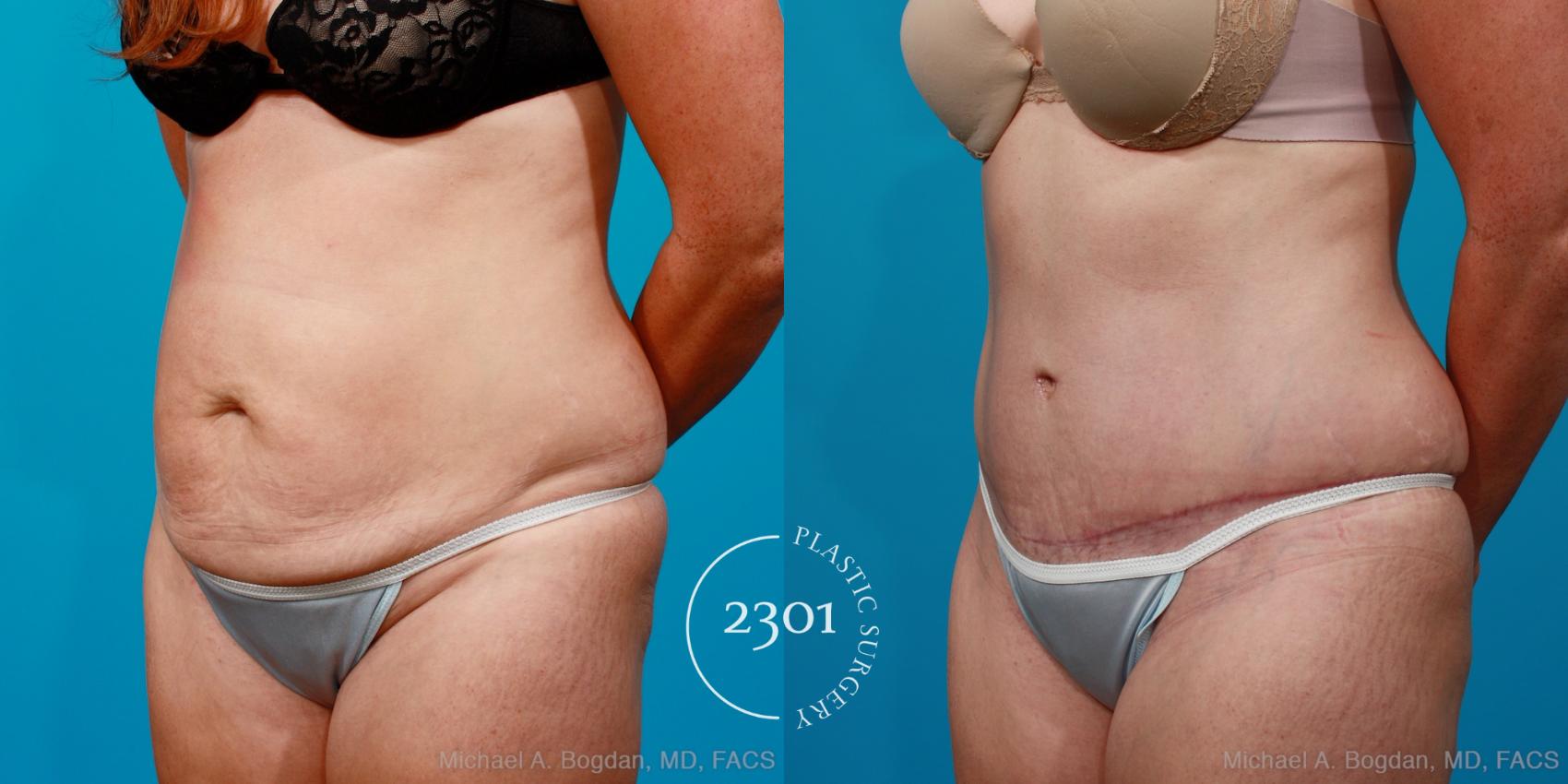 Before & After Tummy Tuck Case 155 View #3 View in Fort Worth, Plano, & Frisco, Texas