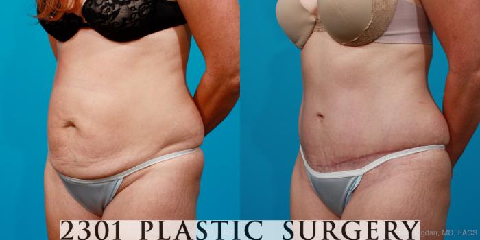 Before & After Tummy Tuck Case 155 View #3 View in Fort Worth, Plano, & Frisco, Texas