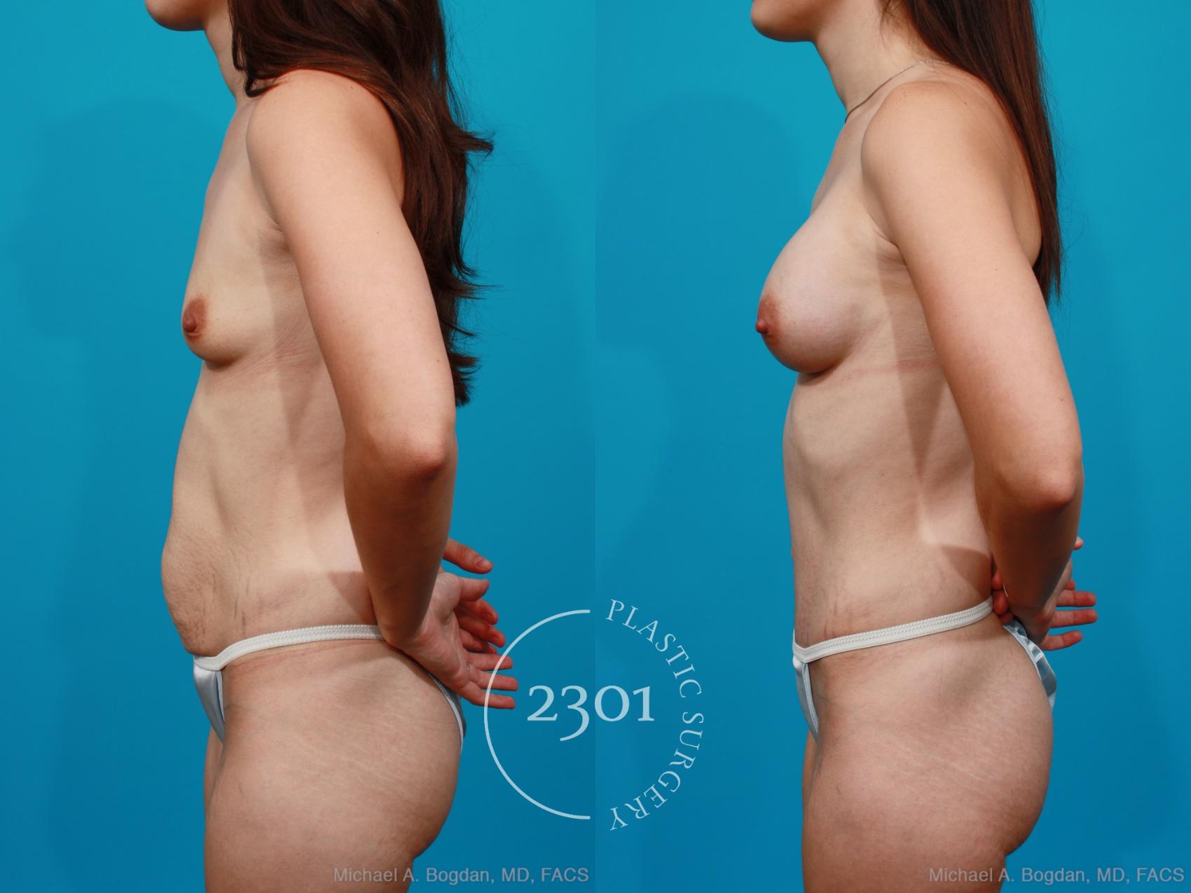 Before & After Breast Augmentation Case 175 View #2 View in Fort Worth, Plano, & Frisco, Texas