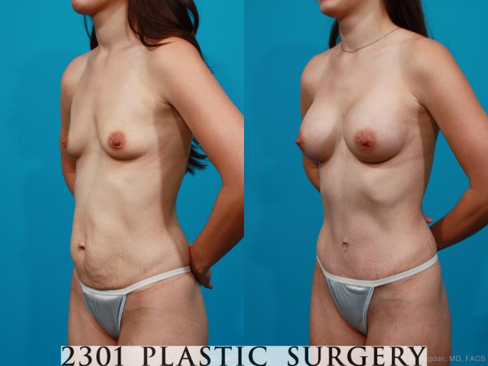 Before & After Breast Augmentation Case 175 View #3 View in Fort Worth, Plano, & Frisco, Texas