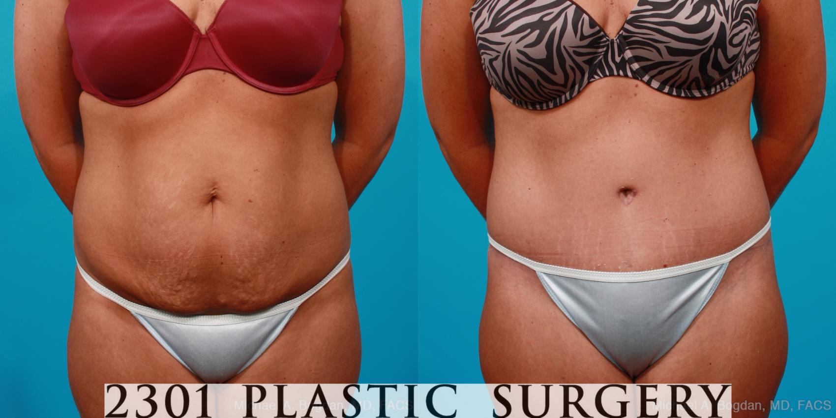 Before & After Tummy Tuck Case 177 View #1 View in Fort Worth, Plano, & Frisco, Texas