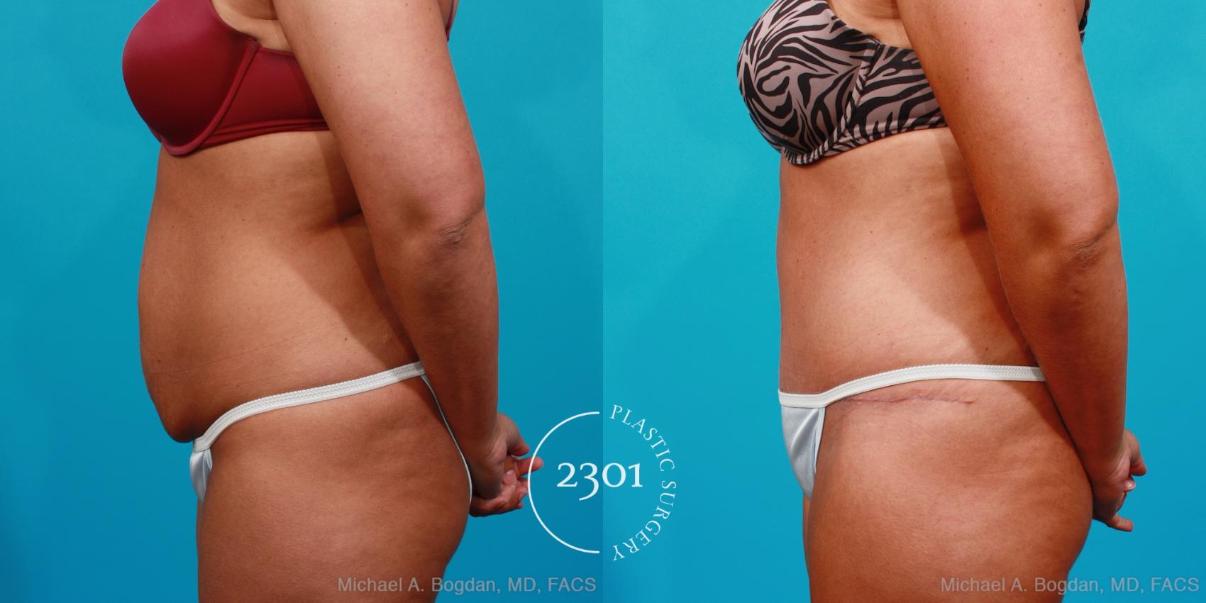 Before & After Tummy Tuck Case 177 View #2 View in Fort Worth, Plano, & Frisco, Texas
