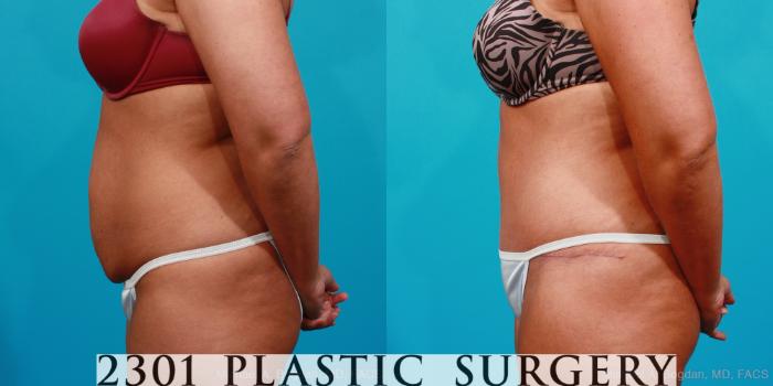 Before & After Tummy Tuck Case 177 View #2 View in Fort Worth, Plano, & Frisco, Texas