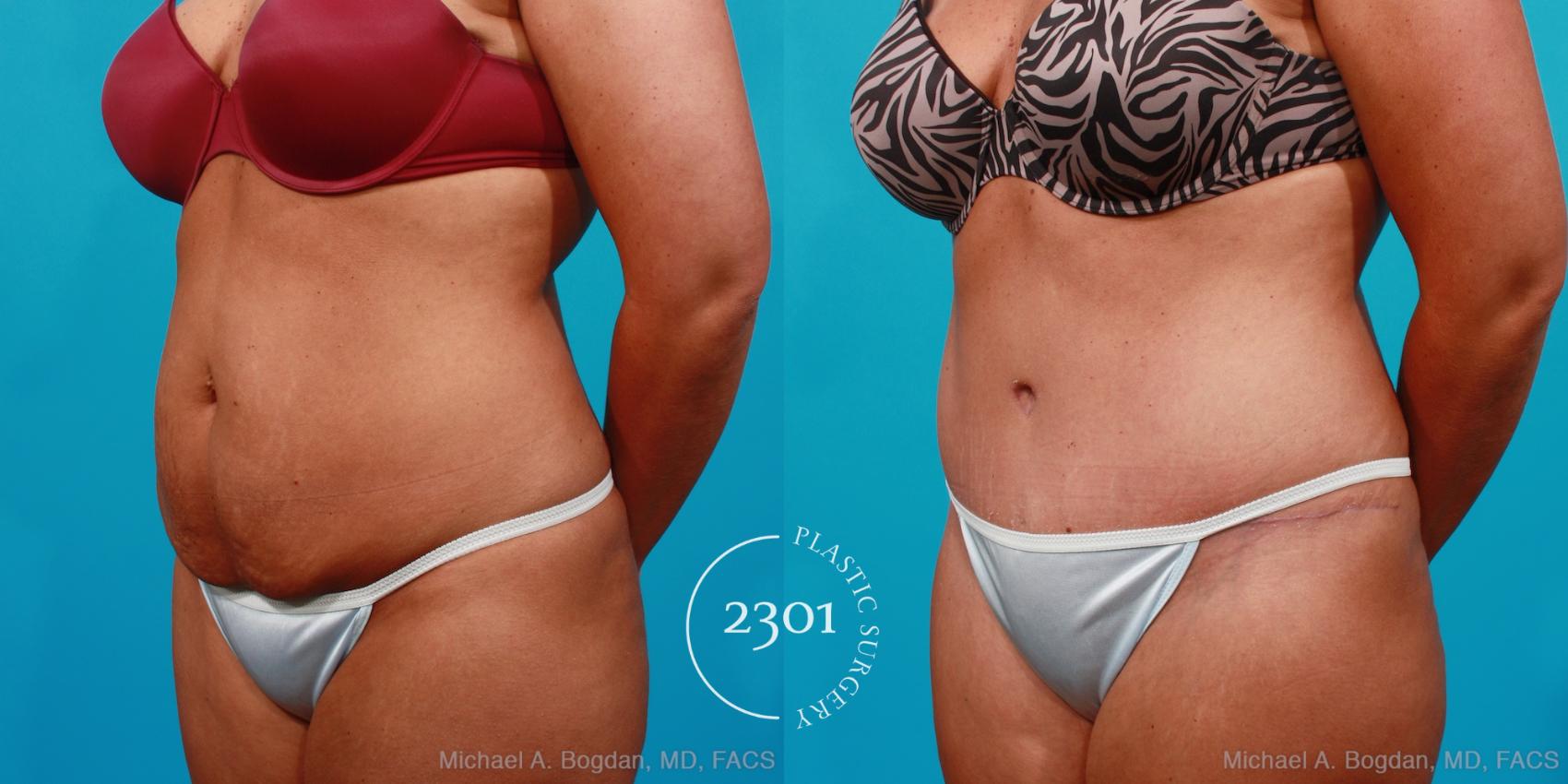 Before & After Tummy Tuck Case 177 View #3 View in Fort Worth, Plano, & Frisco, Texas