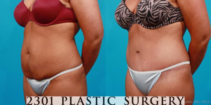Before & After Tummy Tuck Case 177 View #3 View in Fort Worth, Plano, & Frisco, Texas