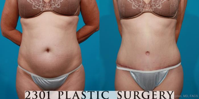 Before & After Tummy Tuck Case 178 View #1 View in Fort Worth, Plano, & Frisco, Texas