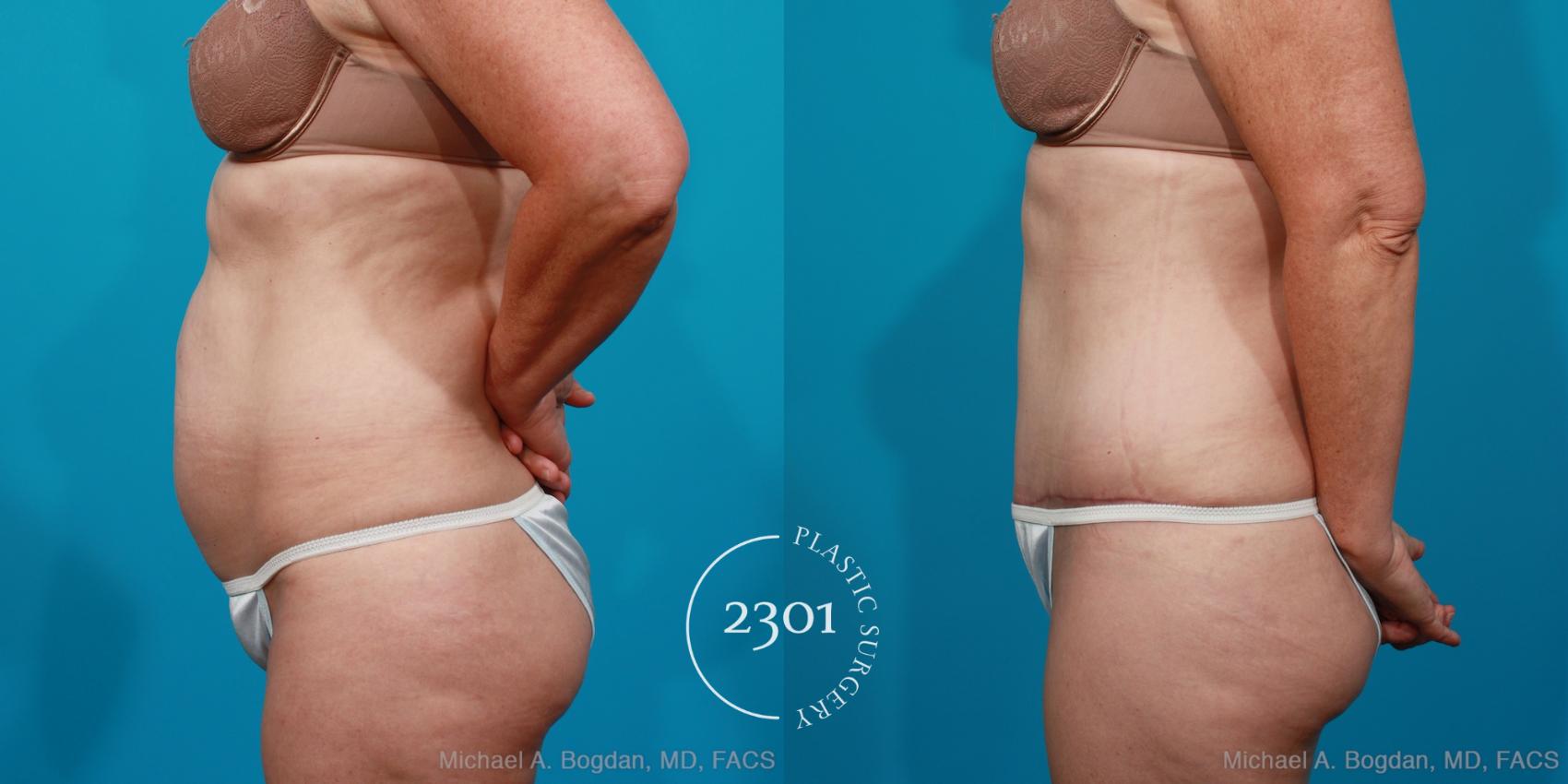 Before & After Tummy Tuck Case 178 View #2 View in Fort Worth, Plano, & Frisco, Texas