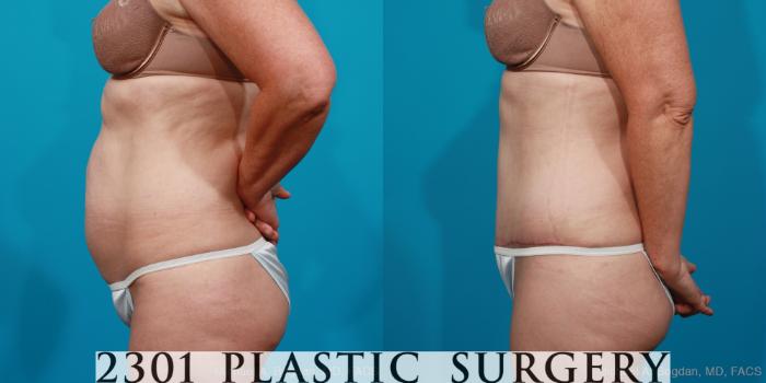 Before & After Tummy Tuck Case 178 View #2 View in Fort Worth, Plano, & Frisco, Texas
