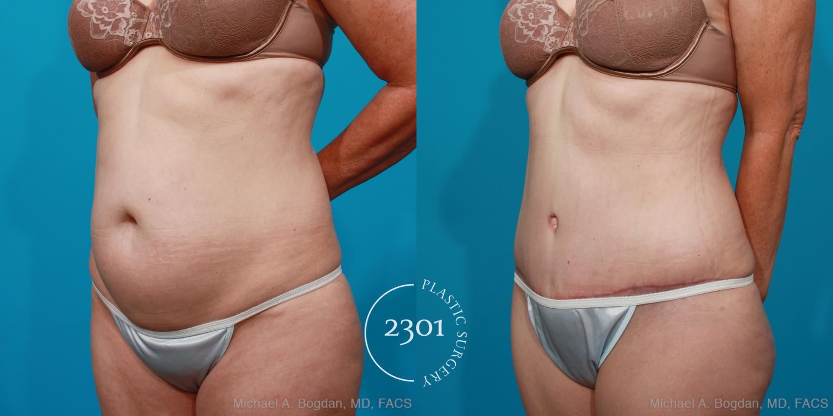 Before & After Tummy Tuck Case 178 View #3 View in Fort Worth, Plano, & Frisco, Texas