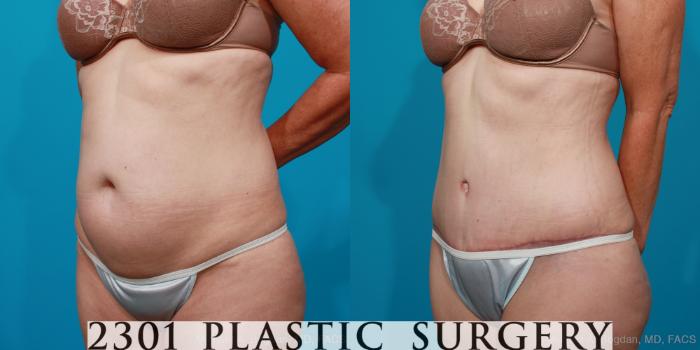 Before & After Tummy Tuck Case 178 View #3 View in Fort Worth, Plano, & Frisco, Texas