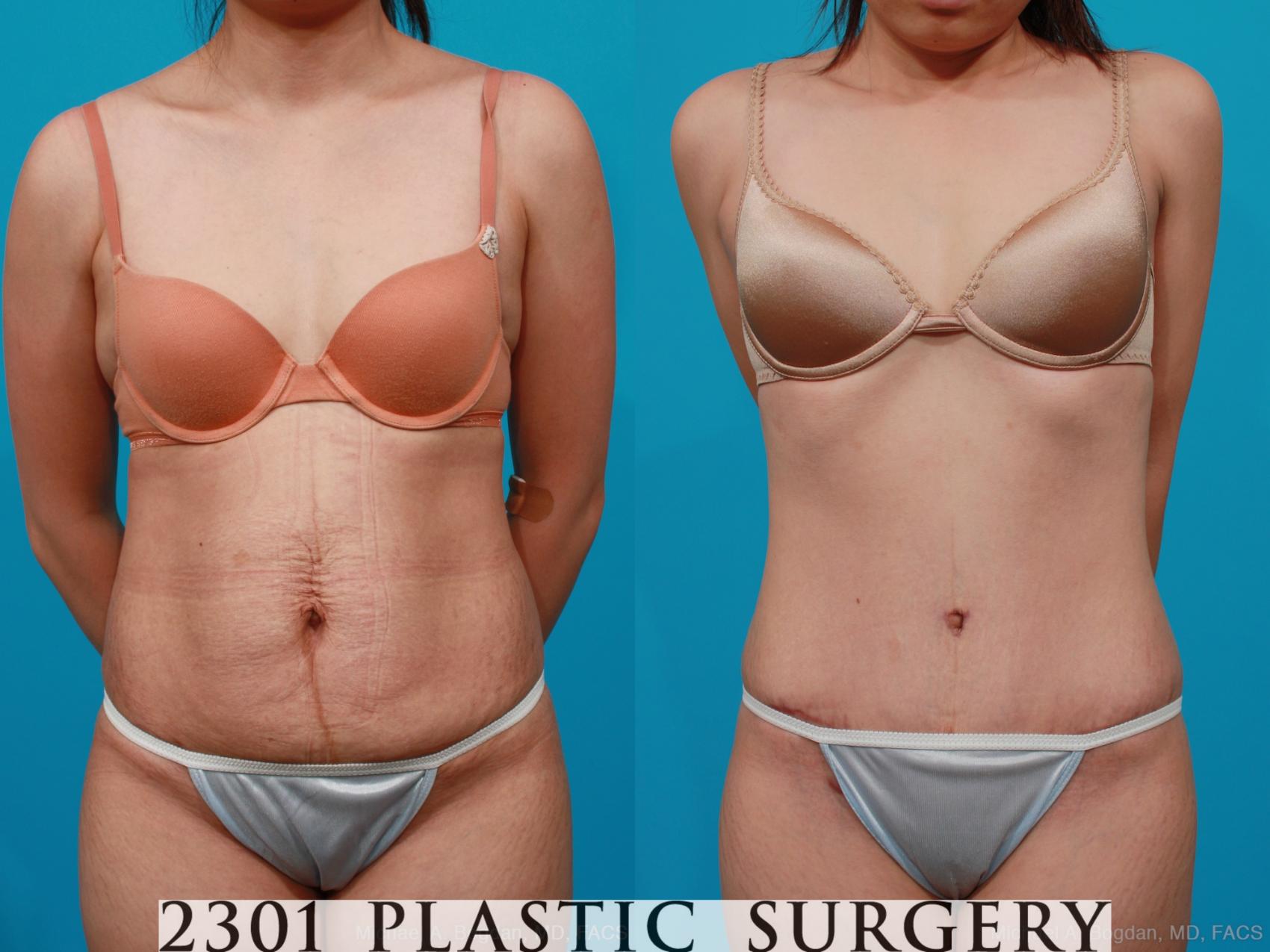 Before & After Tummy Tuck Case 189 View #1 View in Fort Worth, Plano, & Frisco, Texas