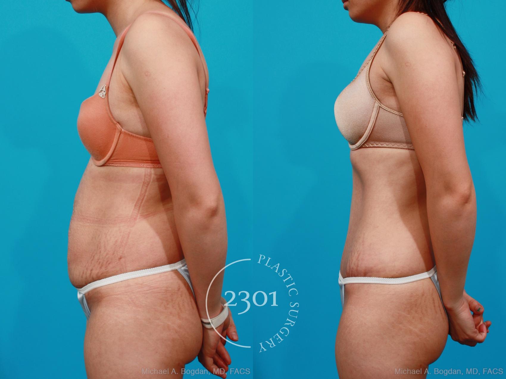 Before & After Tummy Tuck Case 189 View #2 View in Fort Worth, Plano, & Frisco, Texas