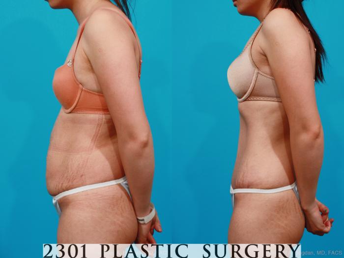Before & After Tummy Tuck Case 189 View #2 View in Fort Worth, Plano, & Frisco, Texas