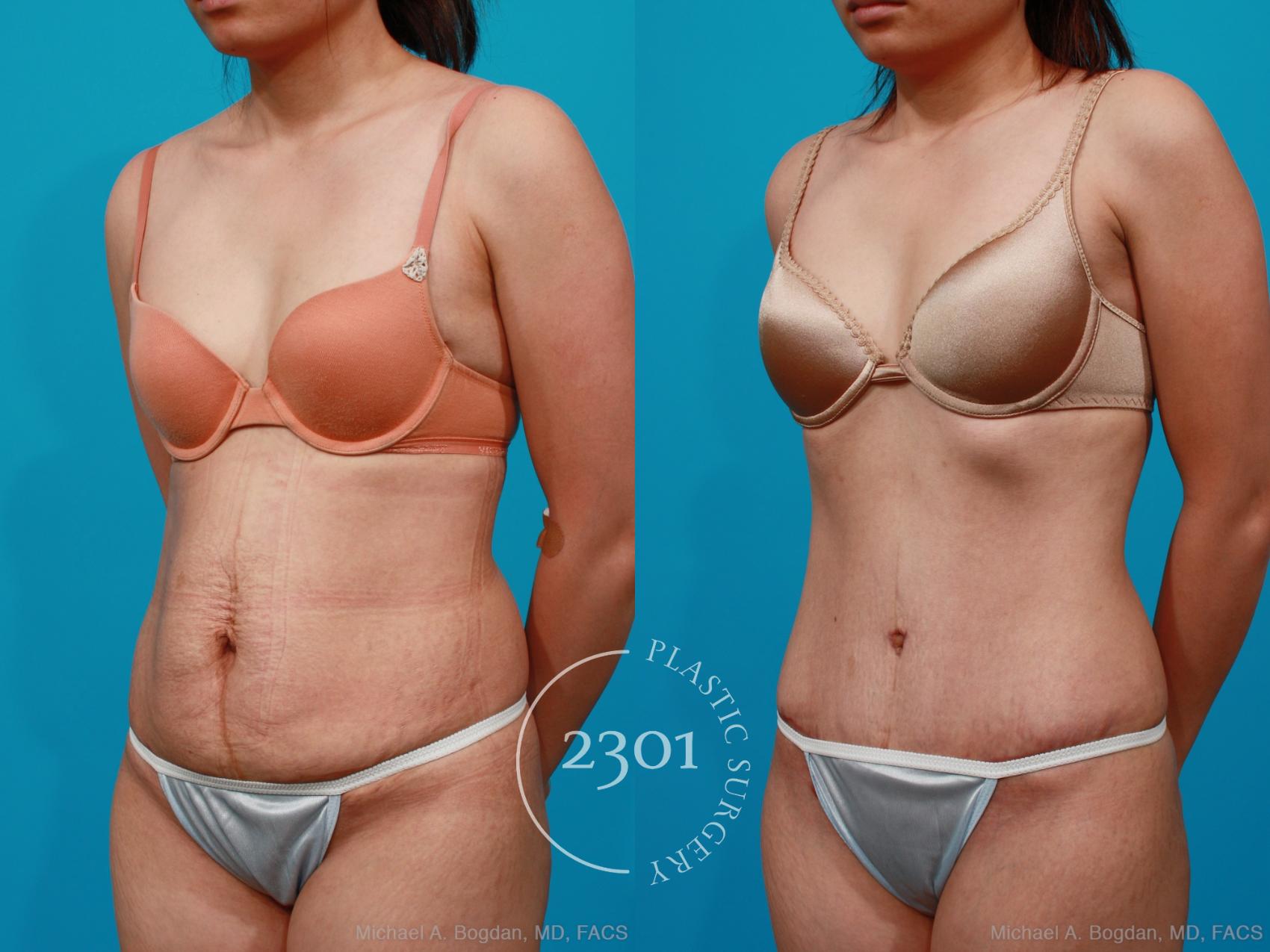 Before & After Tummy Tuck Case 189 View #3 View in Fort Worth, Plano, & Frisco, Texas