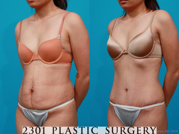 Before & After Tummy Tuck Case 189 View #3 View in Fort Worth, Plano, & Frisco, Texas