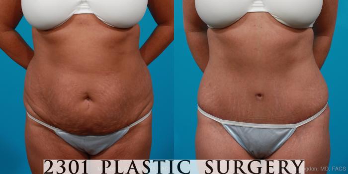 Before & After Tummy Tuck Case 204 View #1 View in Fort Worth, Plano, & Frisco, Texas