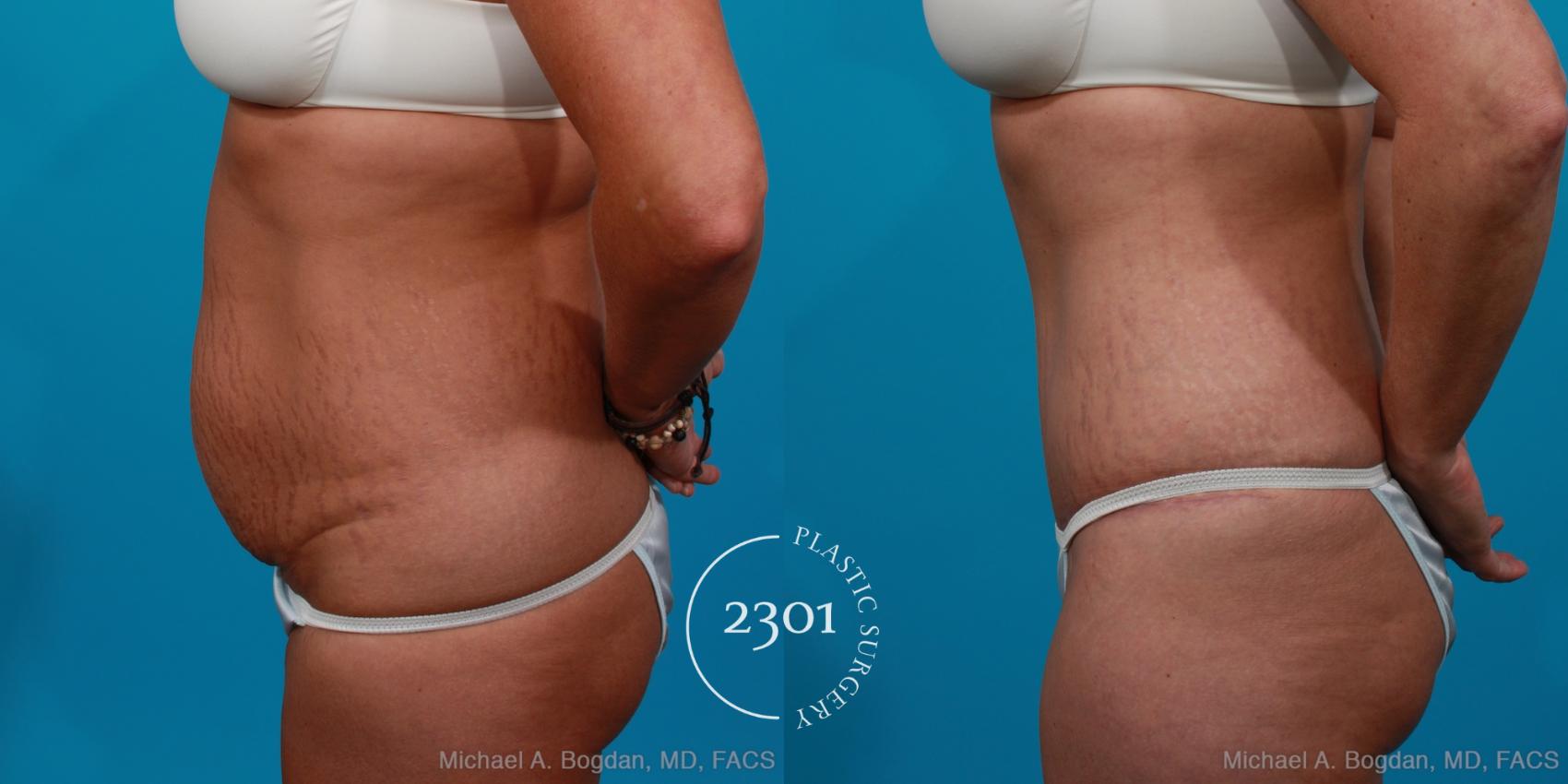 Before & After Tummy Tuck Case 204 View #2 View in Fort Worth, Plano, & Frisco, Texas