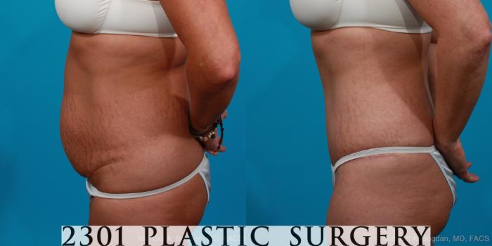 Before & After Tummy Tuck Case 204 View #2 View in Fort Worth, Plano, & Frisco, Texas