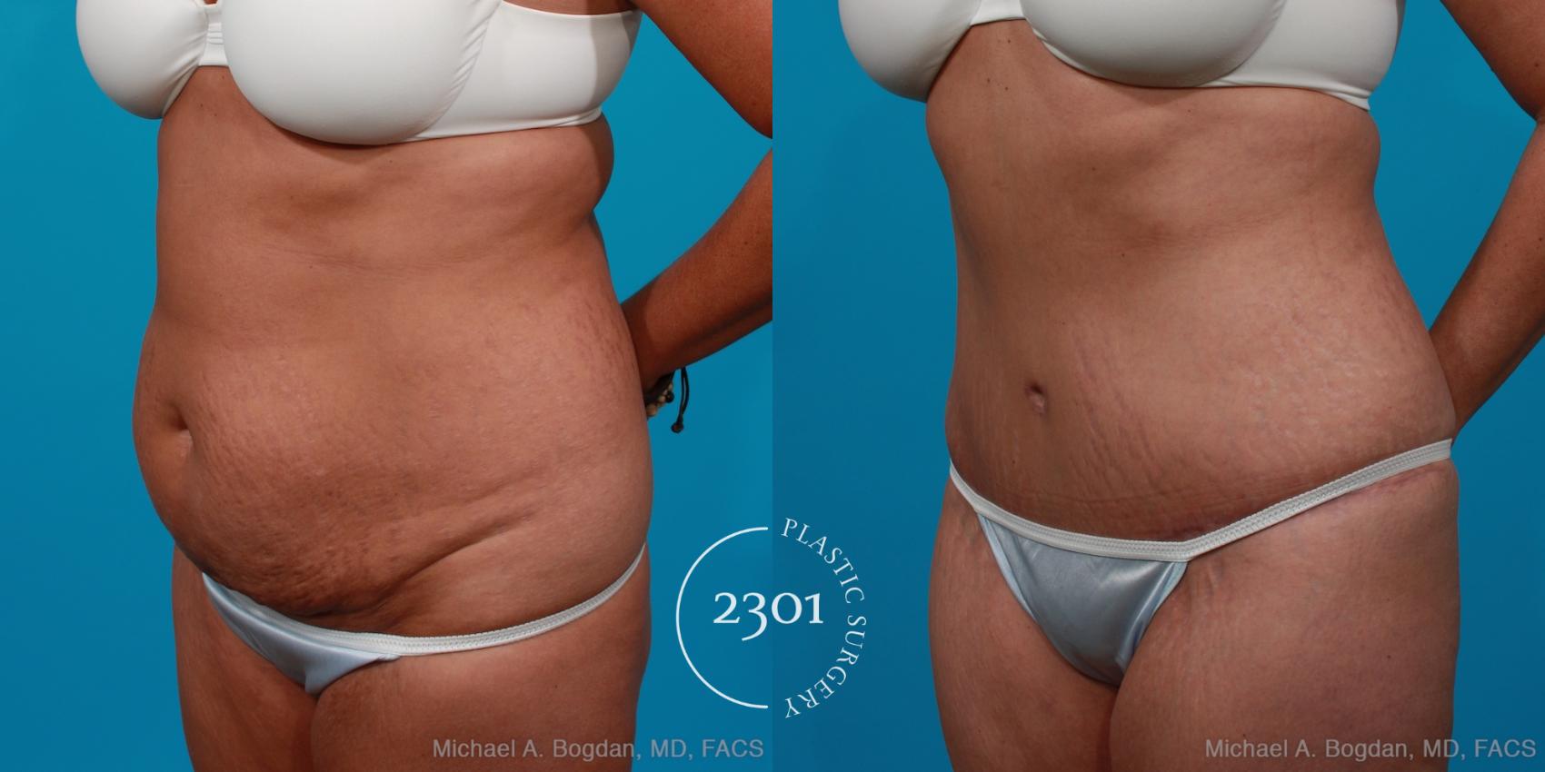 Before & After Tummy Tuck Case 204 View #3 View in Fort Worth, Plano, & Frisco, Texas
