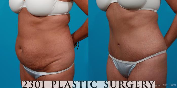 Before & After Tummy Tuck Case 204 View #3 View in Fort Worth, Plano, & Frisco, Texas