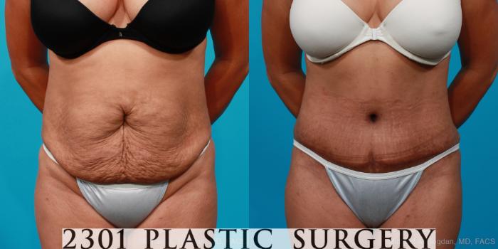 Before & After Tummy Tuck Case 221 View #1 View in Fort Worth, Plano, & Frisco, Texas