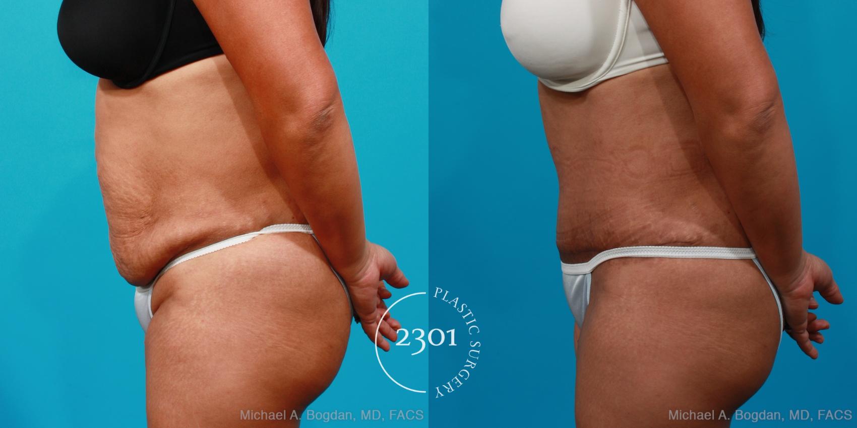 Before & After Tummy Tuck Case 221 View #2 View in Fort Worth, Plano, & Frisco, Texas