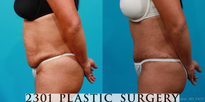 Before & After Tummy Tuck Case 221 View #2 View in Fort Worth, Plano, & Frisco, Texas