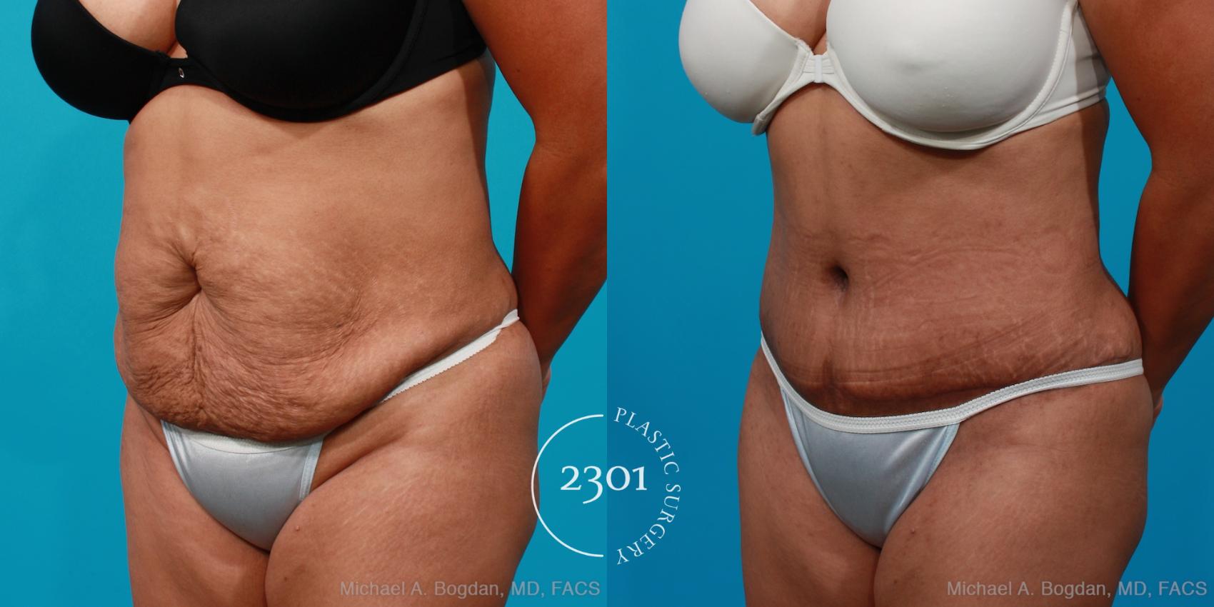 Before & After Tummy Tuck Case 221 View #3 View in Fort Worth, Plano, & Frisco, Texas