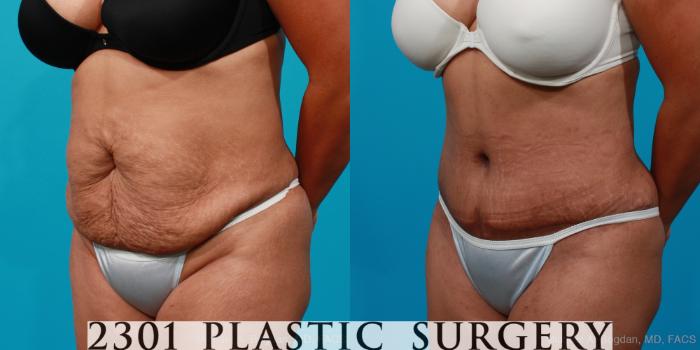 Before & After Tummy Tuck Case 221 View #3 View in Fort Worth, Plano, & Frisco, Texas
