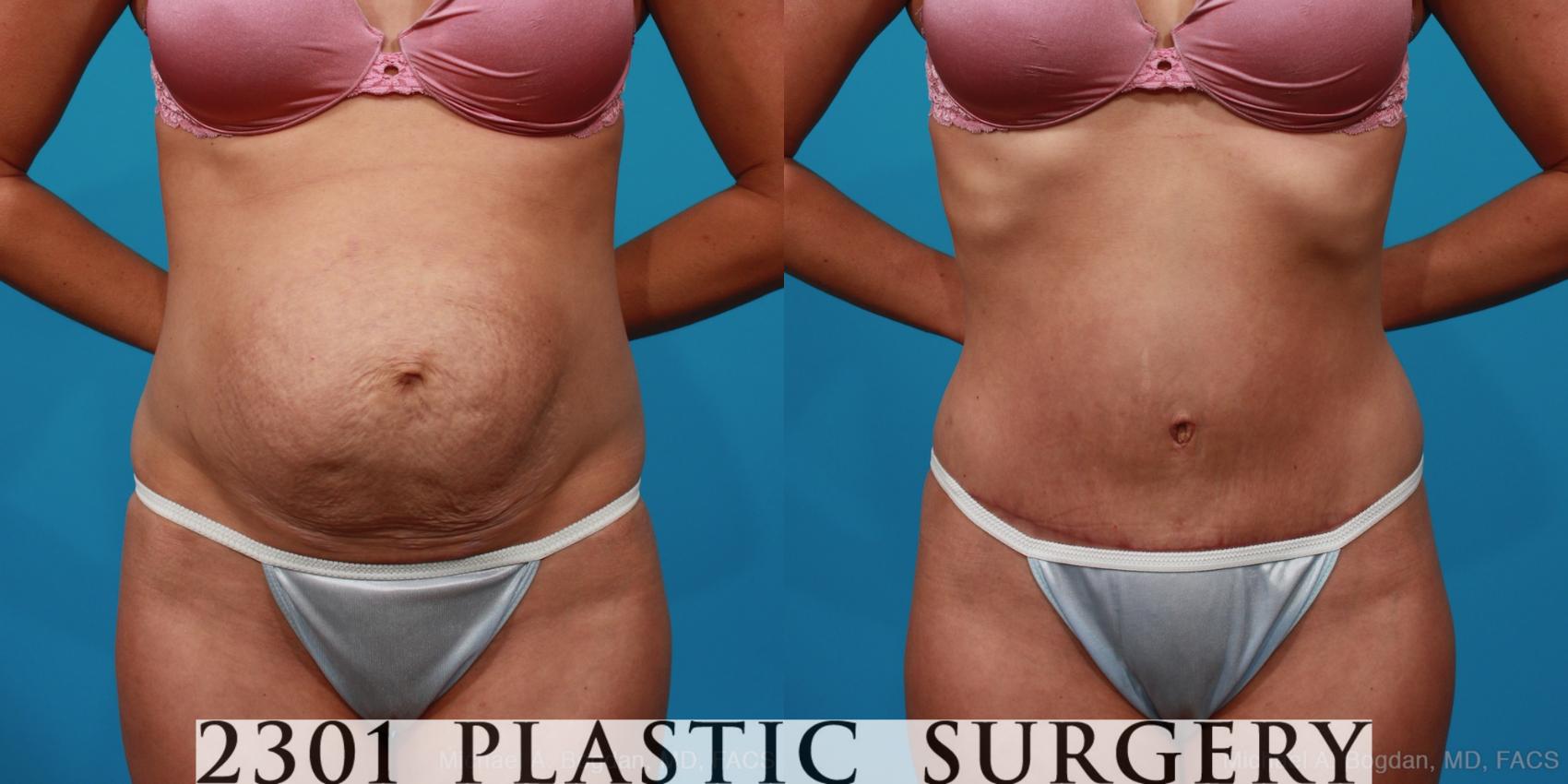 Before & After Tummy Tuck Case 227 View #1 View in Fort Worth & Frisco, Texas