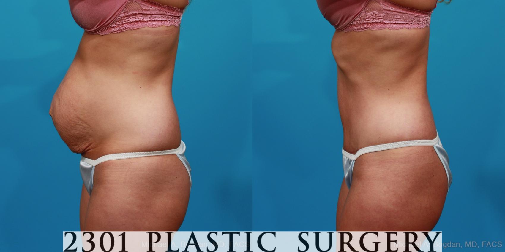 Before & After Tummy Tuck Case 227 View #2 View in Fort Worth, Plano, & Frisco, Texas