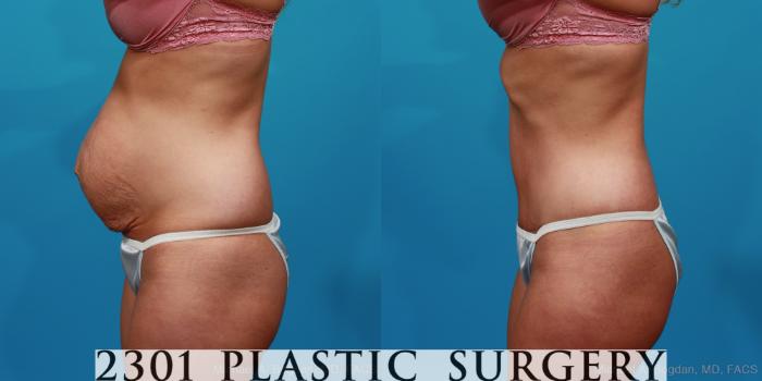 Before & After Tummy Tuck Case 227 View #2 View in Fort Worth & Frisco, Texas