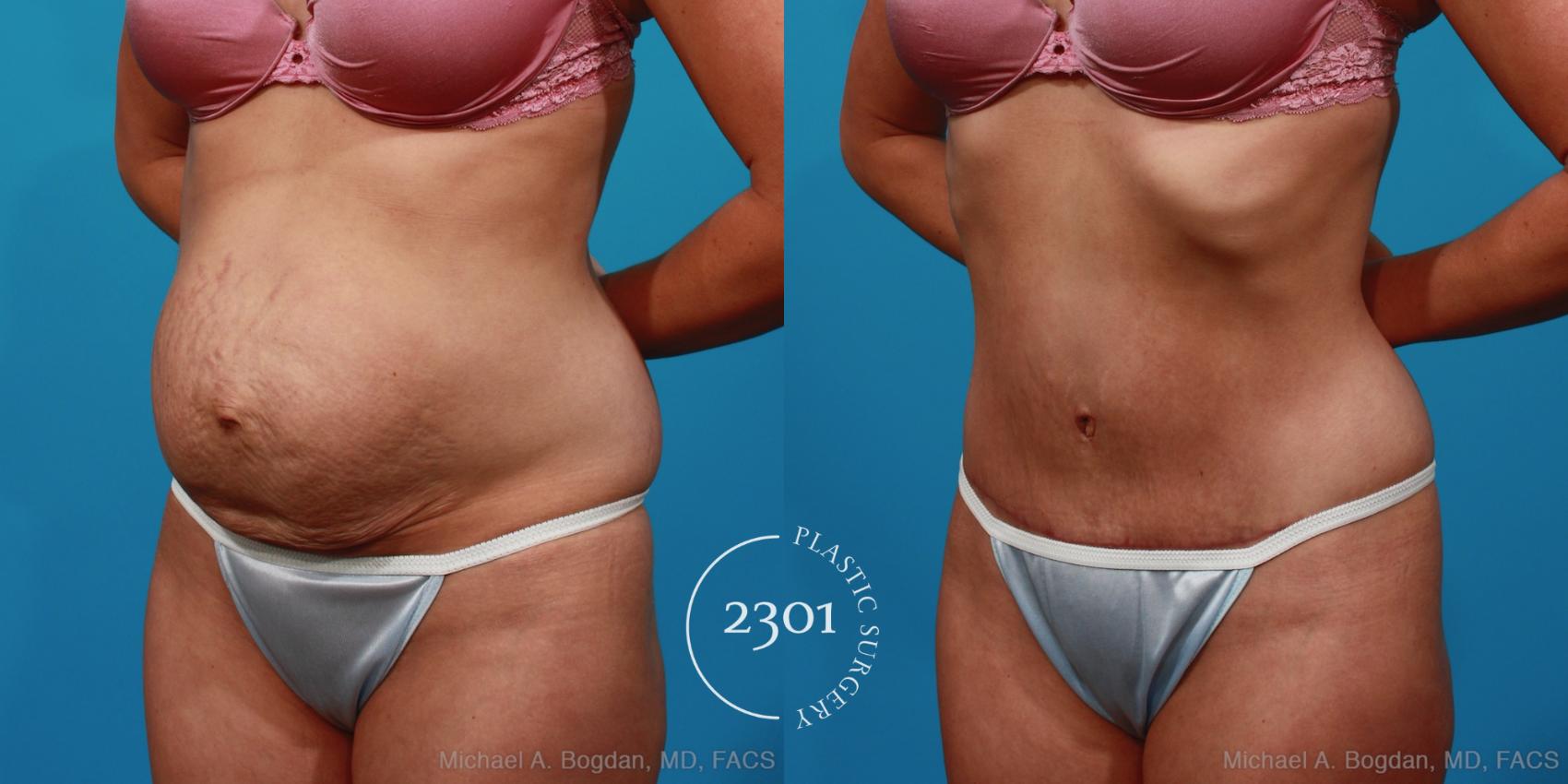 Before & After Tummy Tuck Case 227 View #3 View in Fort Worth, Plano, & Frisco, Texas