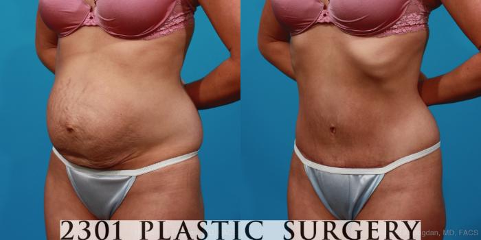 Before & After Tummy Tuck Case 227 View #3 View in Fort Worth & Frisco, Texas