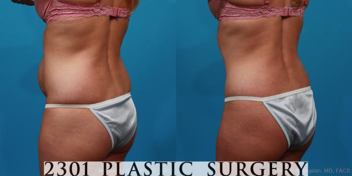 Before & After Tummy Tuck Case 227 View #4 View in Fort Worth & Frisco, Texas