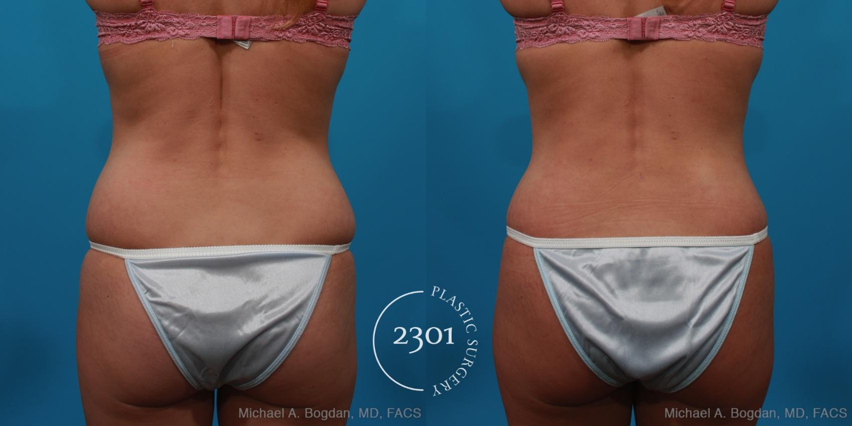 Before & After Tummy Tuck Case 227 View #5 View in Fort Worth, Plano, & Frisco, Texas