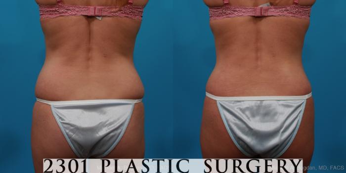 Before & After Tummy Tuck Case 227 View #5 View in Fort Worth & Frisco, Texas