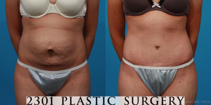 Before & After Tummy Tuck Case 235 View #1 View in Fort Worth, Plano, & Frisco, Texas